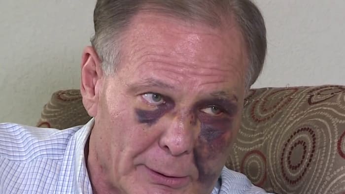 ONLY ON 2: 68-year-old man beaten by burglar grateful after investigators arrest alleged attacker - Vimarsana News