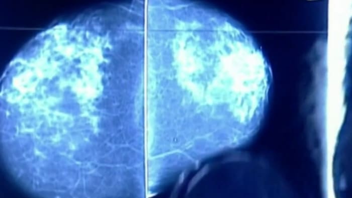 Medics encourage early screenings as statistics show Black women suffer higher breast cancer death rates - Vimarsana News