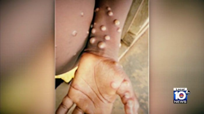 Monkeypox deemed public health emergency; South Florida seeing most cases  in state