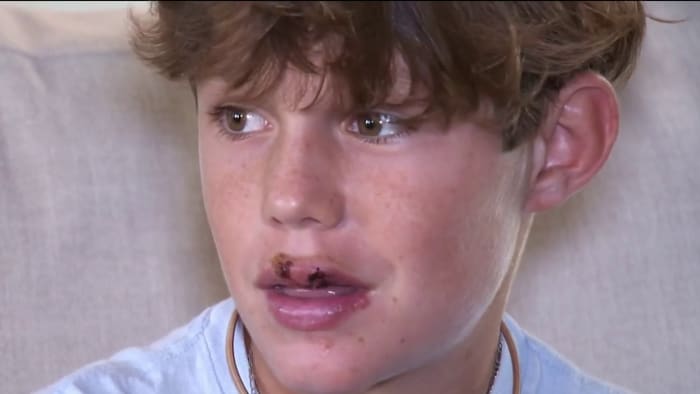 ‘It was so fast:’ Shark bites Oviedo teen during family trip to Florida Keys