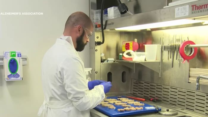 Texas Alzheimers patient calls new treatment lifechanging