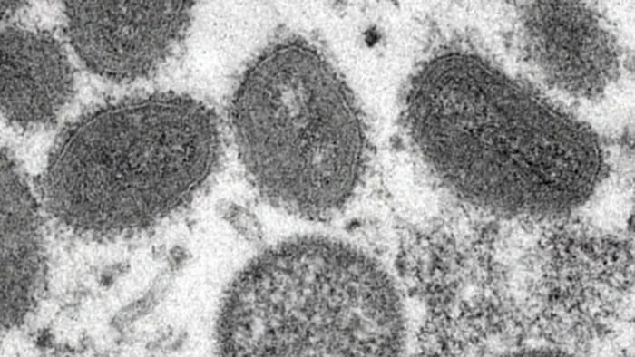 Well being authorities should warn populations about monkeypox with out stigmatizing them