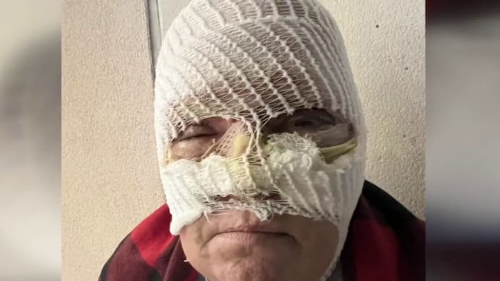 Woman wakes up to horrific acid attack