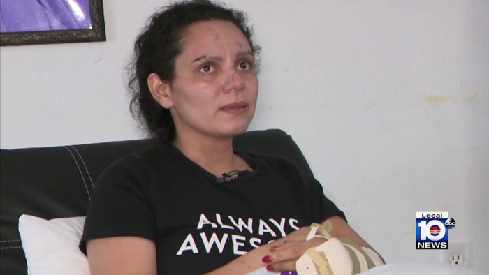 Miami woman wondering how she’ll pay medical bills following violent crash that took her leg