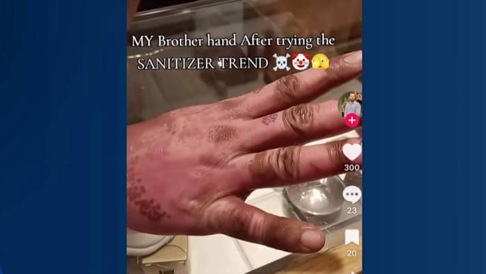 Viral social media challenges linked to severe burn injuries in children, doctors say