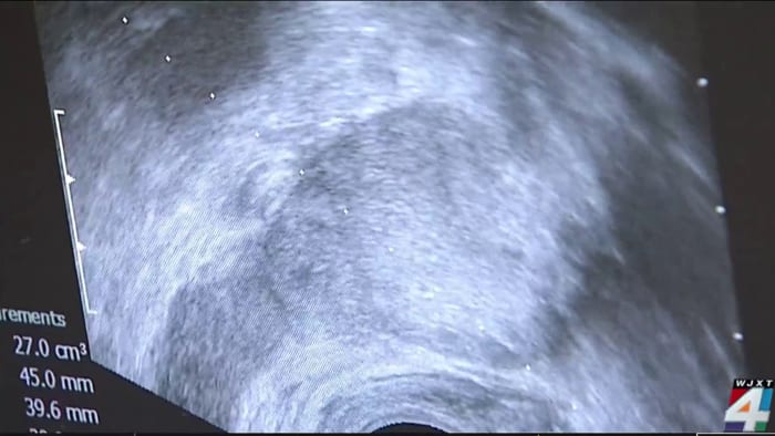 New imaging tool is lighting up prostate cancer - Vimarsana News