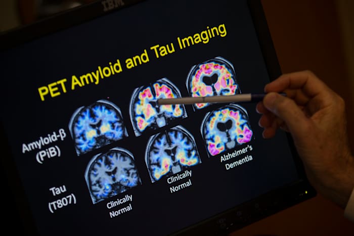 FDA OKs first blood test that can help diagnose Alzheimer’s disease