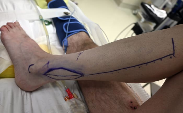 Montana man to return home from hospital weeks after grizzly bear bit off lower jaw