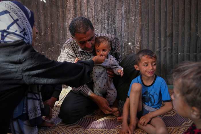 Takeaways from AP's reporting on child malnutrition in Gaza