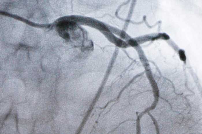 FDA May Fast-Track Enlicitide: LDL Cholesterol Slashed by 60%