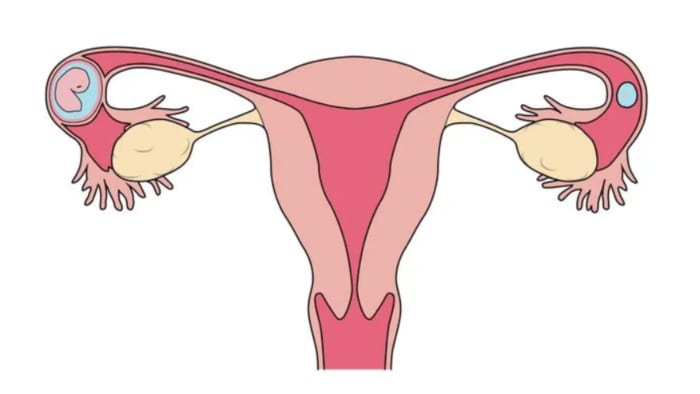 What is an ectopic pregnancy? How it occurs and the dangers it presents What is an ectopic pregnancy? How it occurs and the dangers it presents