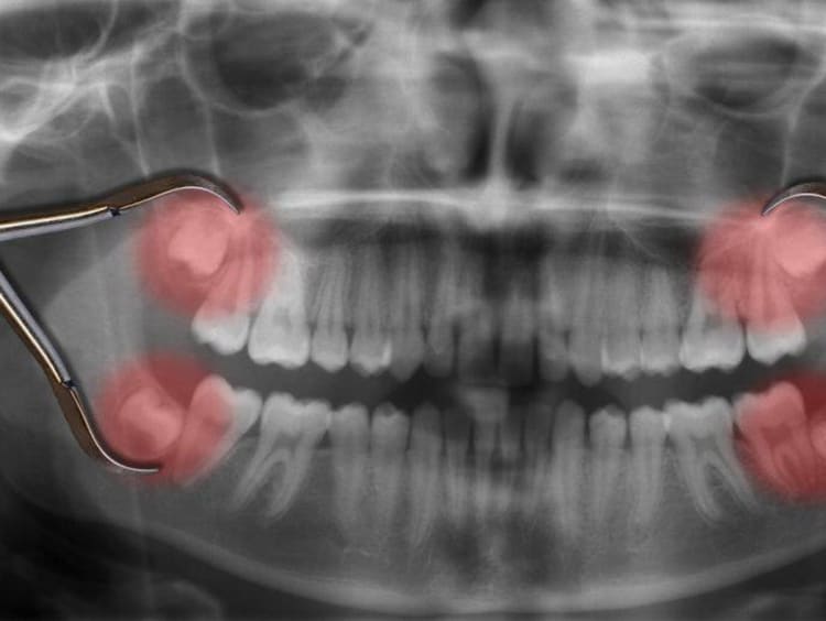 Dental x-ray with red emphasis on the wisdom teeth