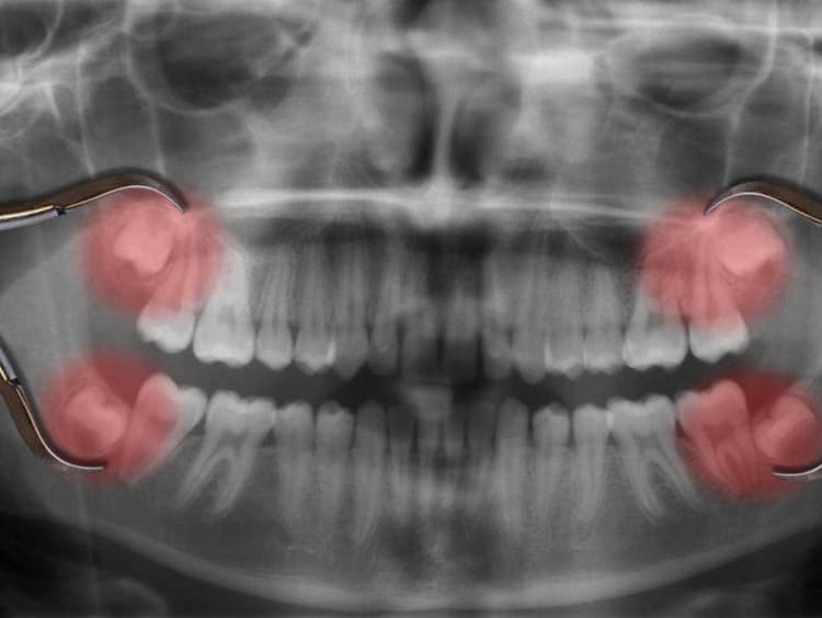 Dental x-ray with red emphasis on the wisdom teeth