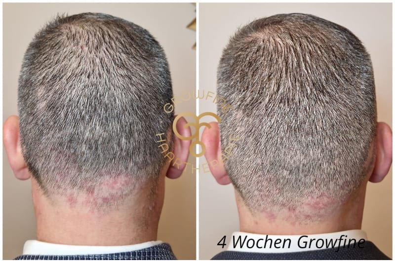 nach 4 Wochen zu mehr Haarfülle | © 4 Wochen Growfine Set