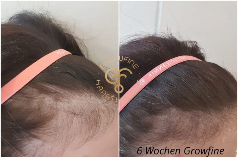 nach 6 Wochen weniger Geheimratsecken | © 6 Wochen Growfine Set