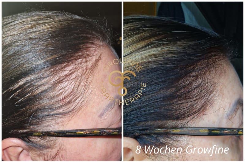 Haarausfall in den Wechseljahren reduzieren | © 8 Wochen Growfine Set