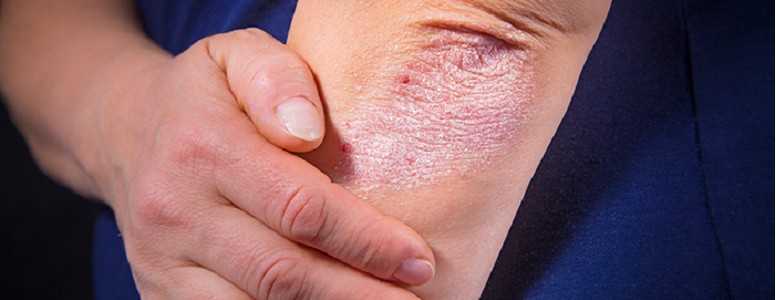psoriasis forum uk