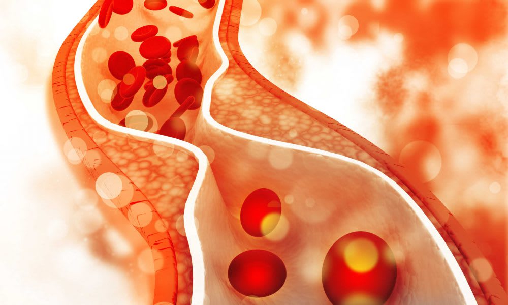 Dyslipidemia unbalanced or unhealthy cholesterol levels