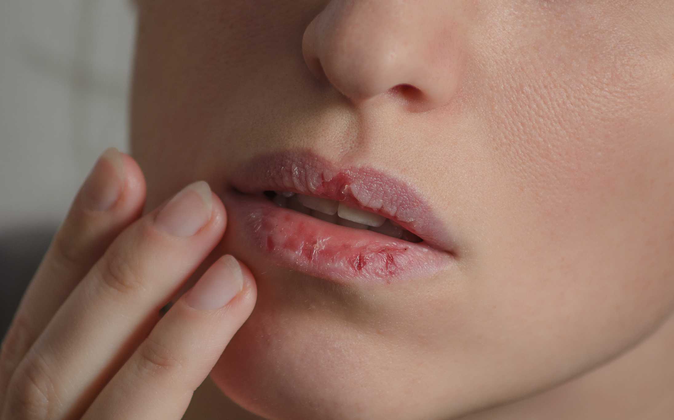 fungal infection on lips