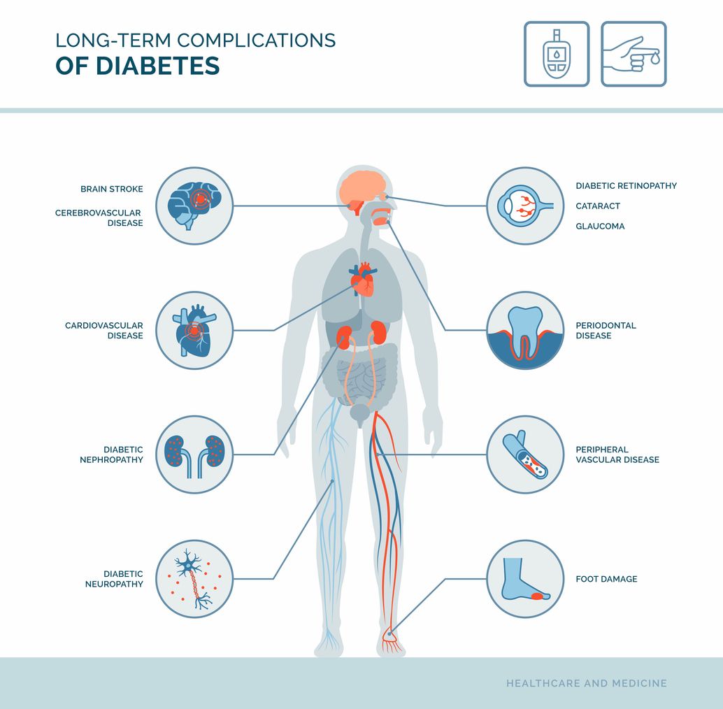 Type 2 diabetes and life expectancy