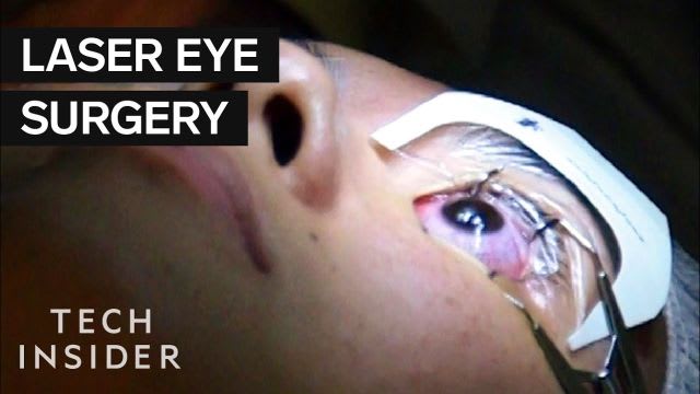 What It's Like To Get Laser Eye Surgery