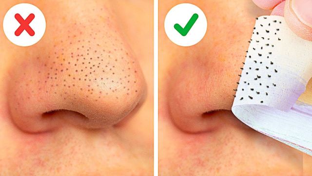 22 EASY WAYS TO REMOVE BLACKHEADS FAST || FACE MASKS, NATURAL BEAUTY HACKS