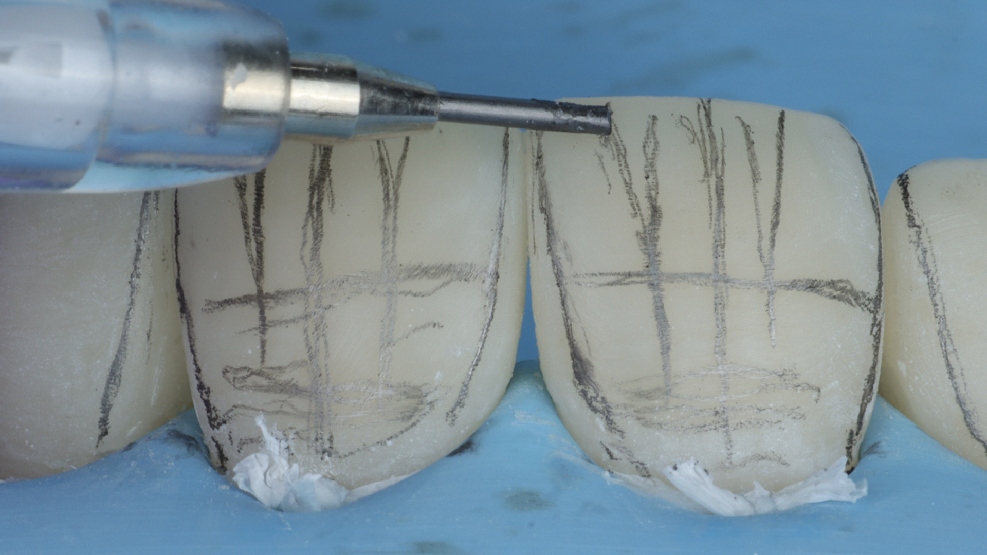 Clinical example illustrating shape and contour of an anterior composite restoration