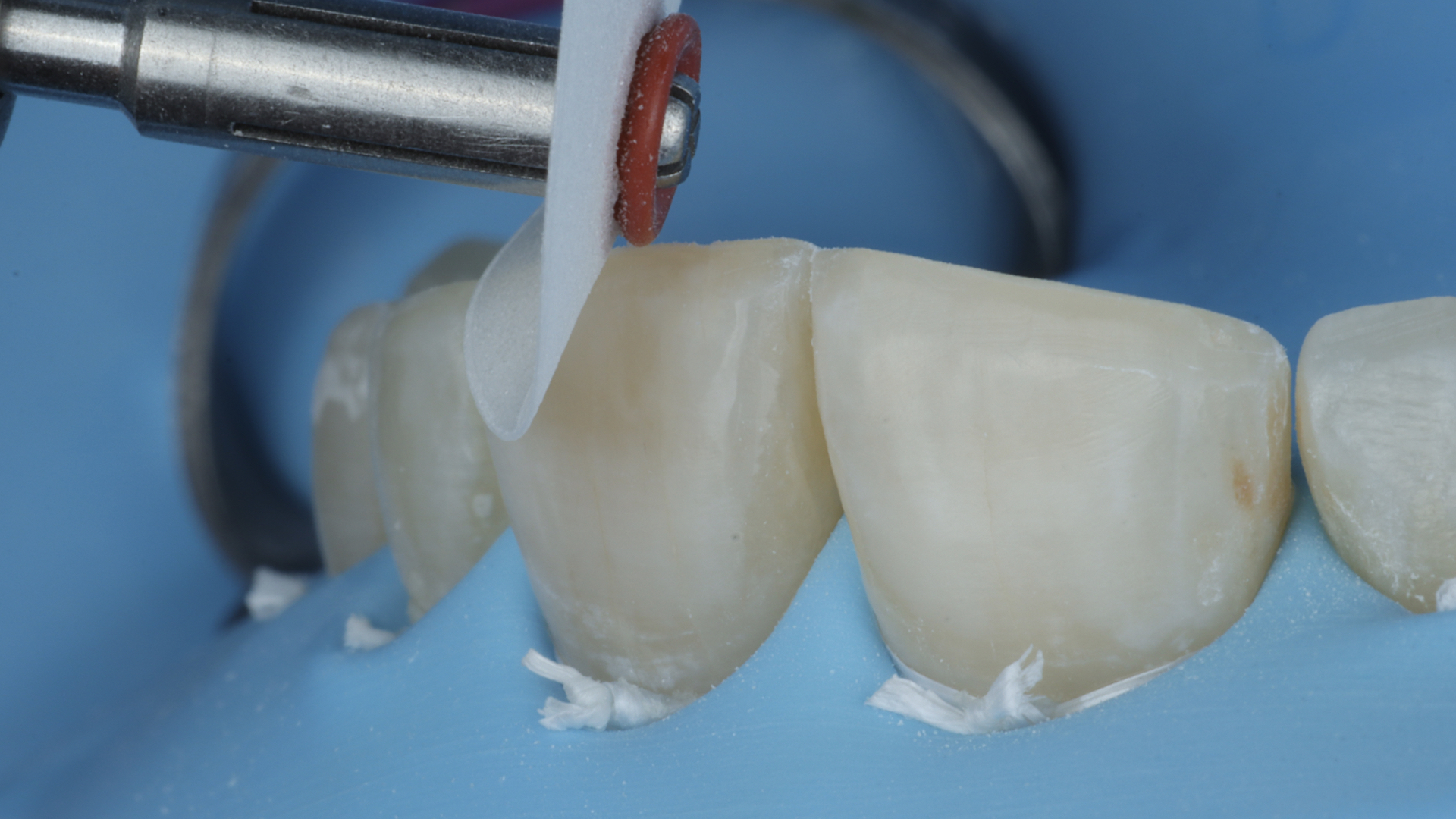 Final surface texture and characterization of anterior composite restoration