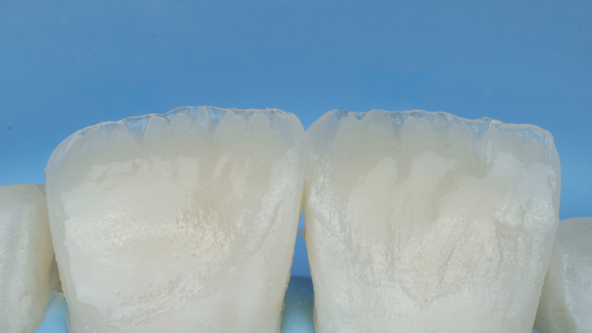 Composite layering technique for anterior restoration