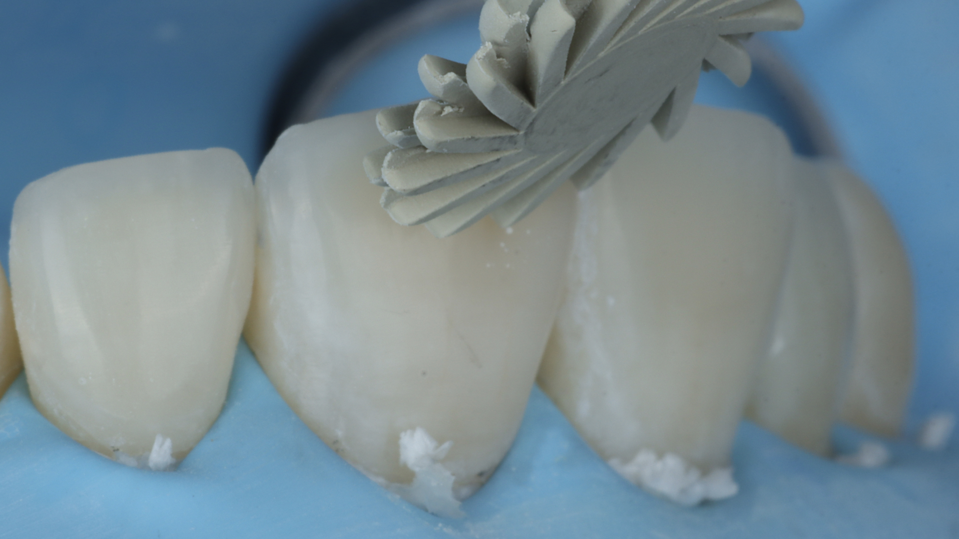 Clinical example illustrating finishing and surface texture of an anterior composite restoration
