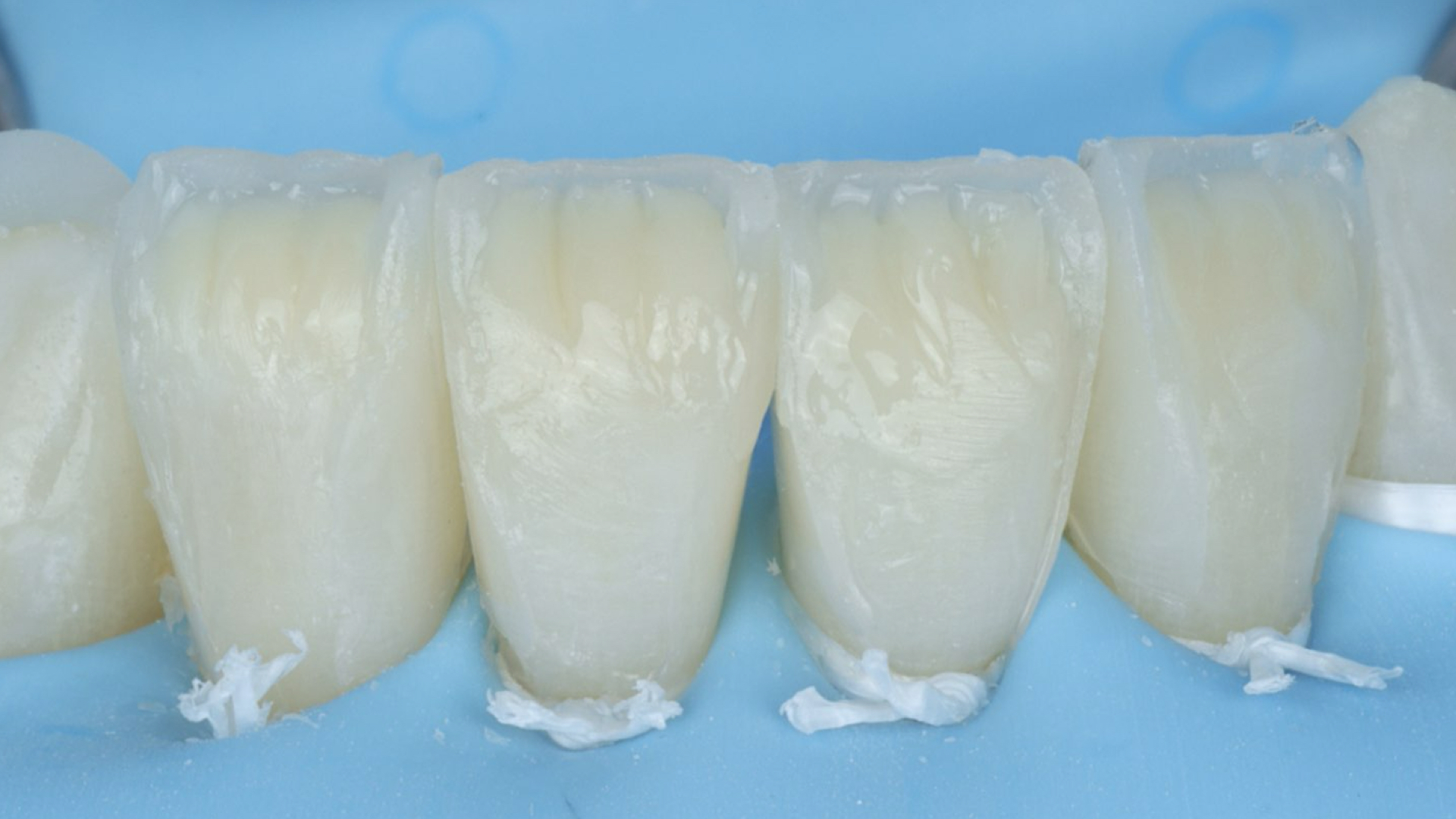 Clinical example illustrating simplified shade selection with composite layering
