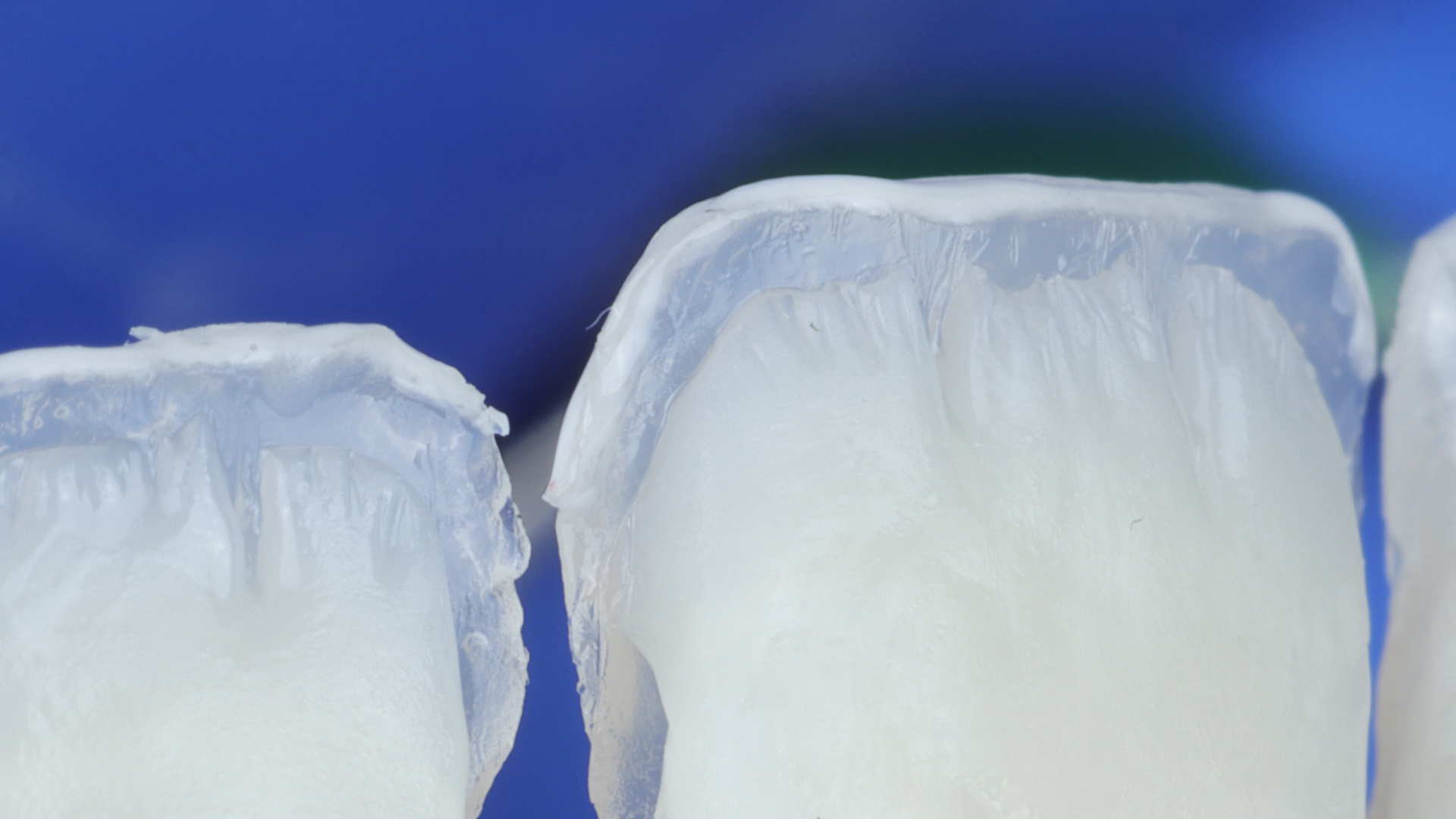 Natural aesthetics achieved with anterior composite restoration