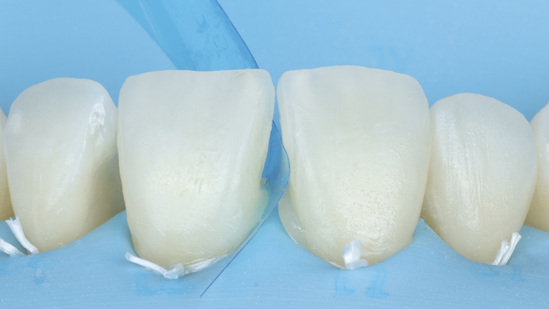 Clinical example illustrating tooth proportions and space closure