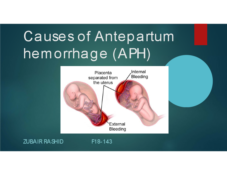 Causes of APH New.pdf