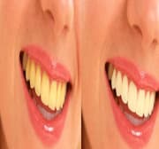 teeth color.jpg