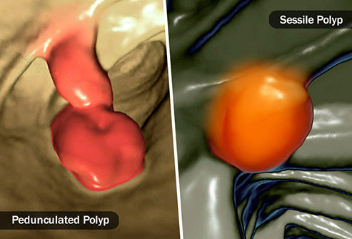 Pedunculated polyp and Sessile polyp
