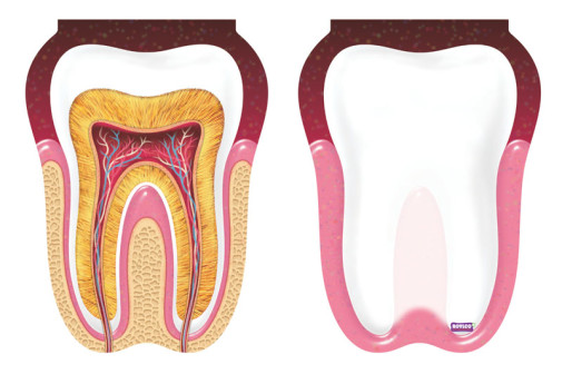 Widsom Tooth Pad