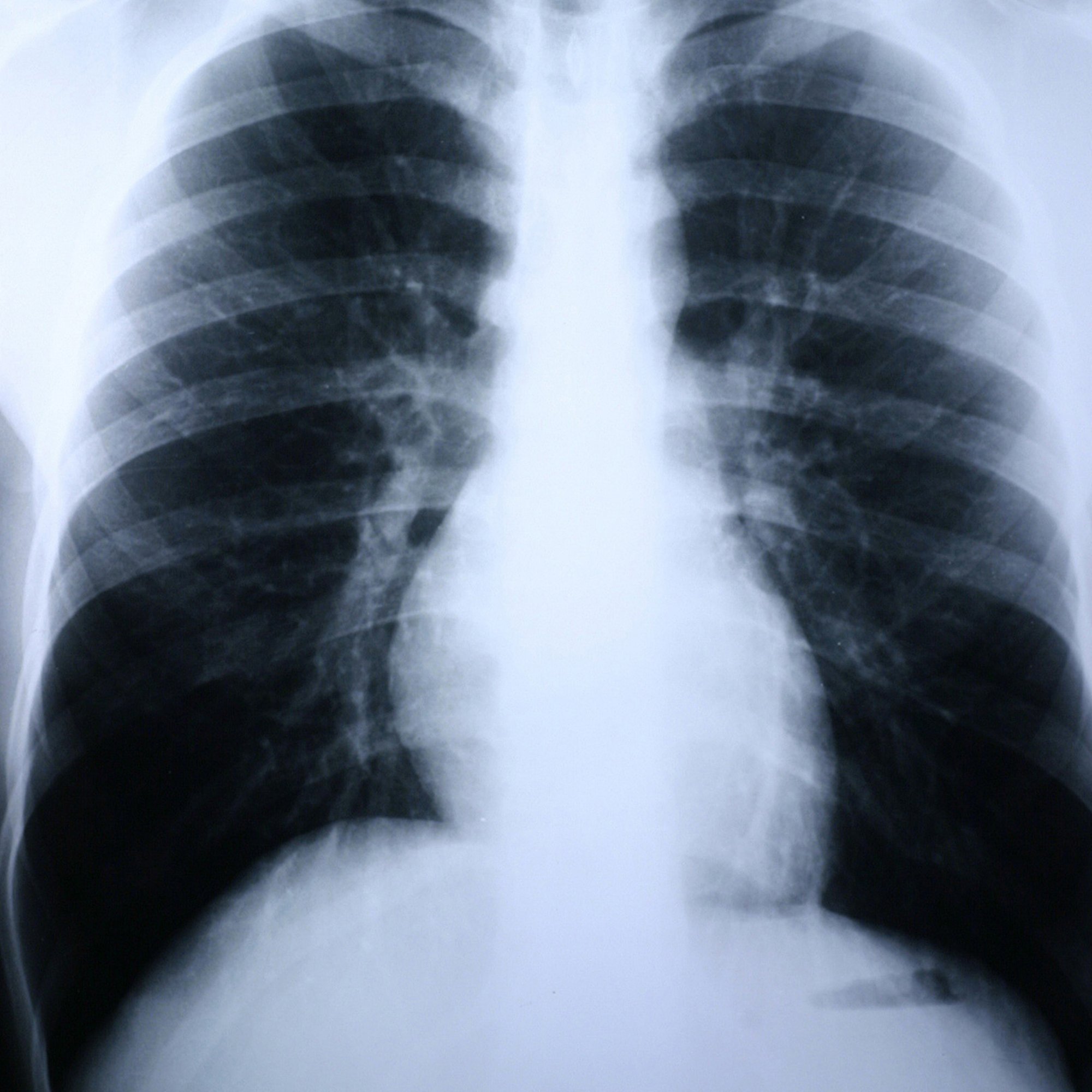 Clear Choice Performance X-Ray Film MK 381332