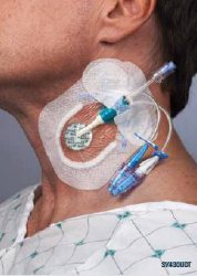 Integrated Securement Dressing Sorbaview SHIELD Fabric / Film 3-3/4 X 4-3/4 Inch Sterile MK 981657