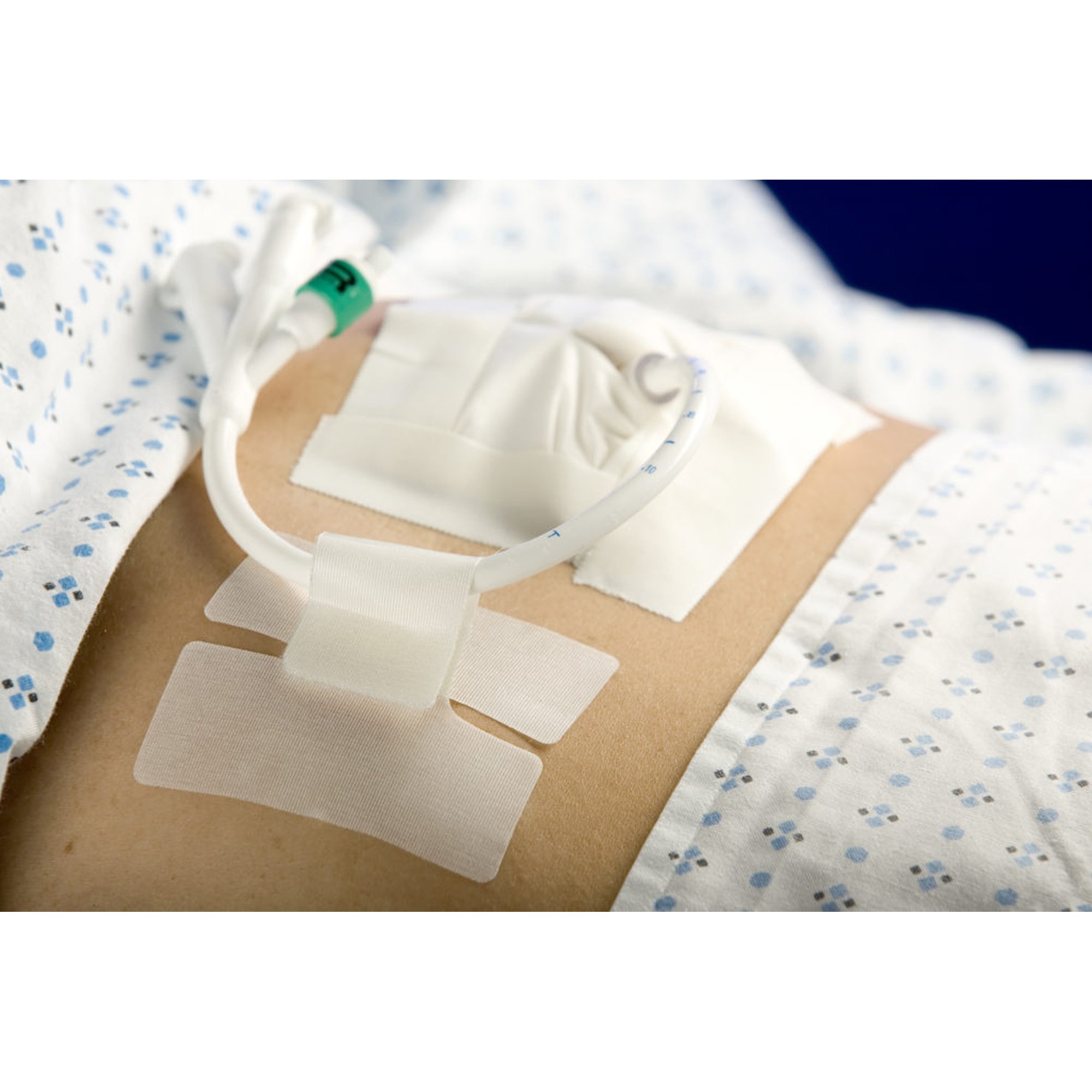 Cath-Secure Holder, Tube MK 192067