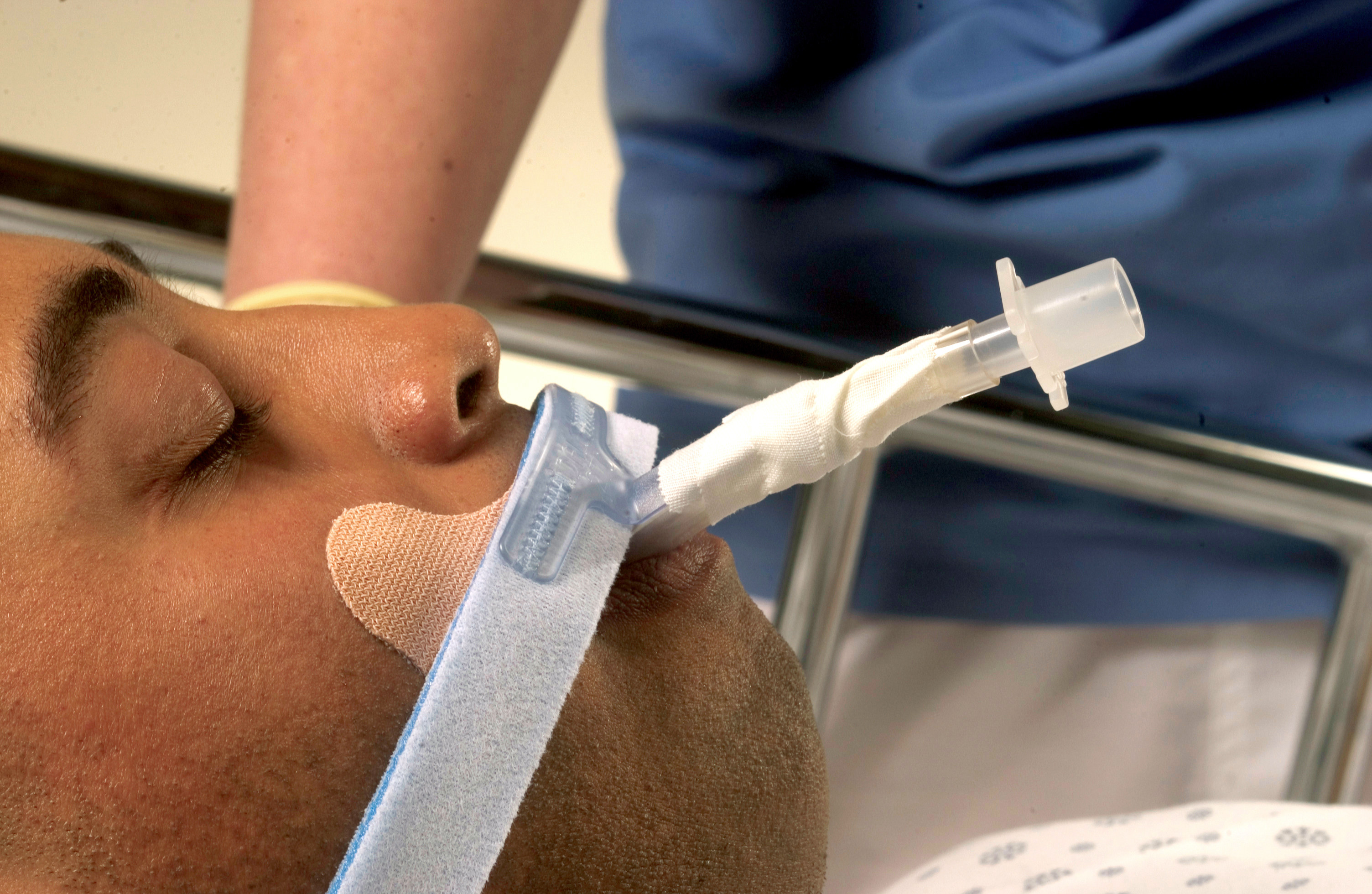 Stabilock Endotracheal Tube Holder MK 344536