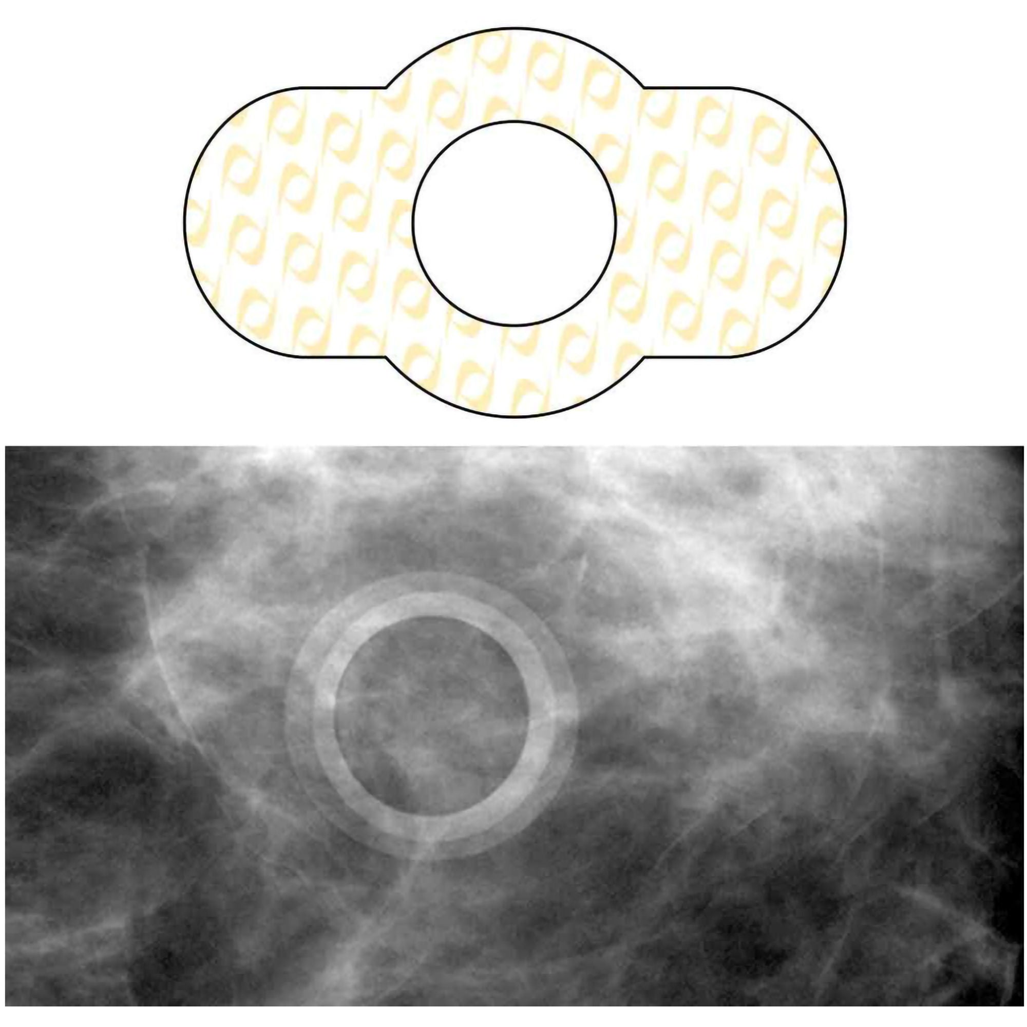 Spee-D-Ring Skin Marker MK 880906