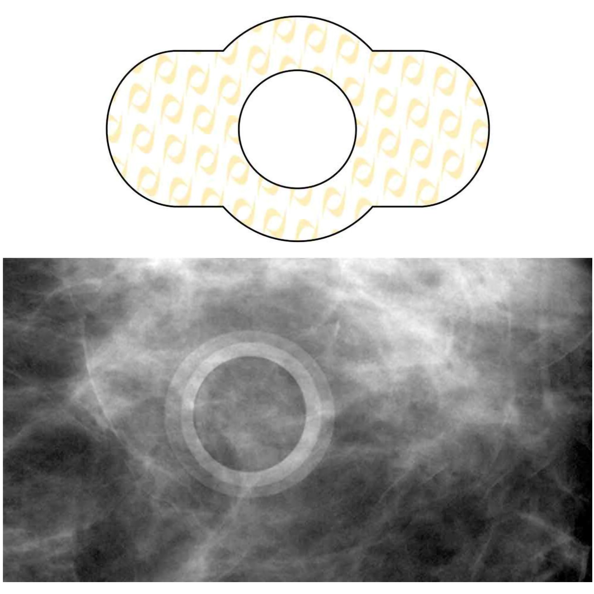 Spee-D-Ring Skin Marker MK 880906