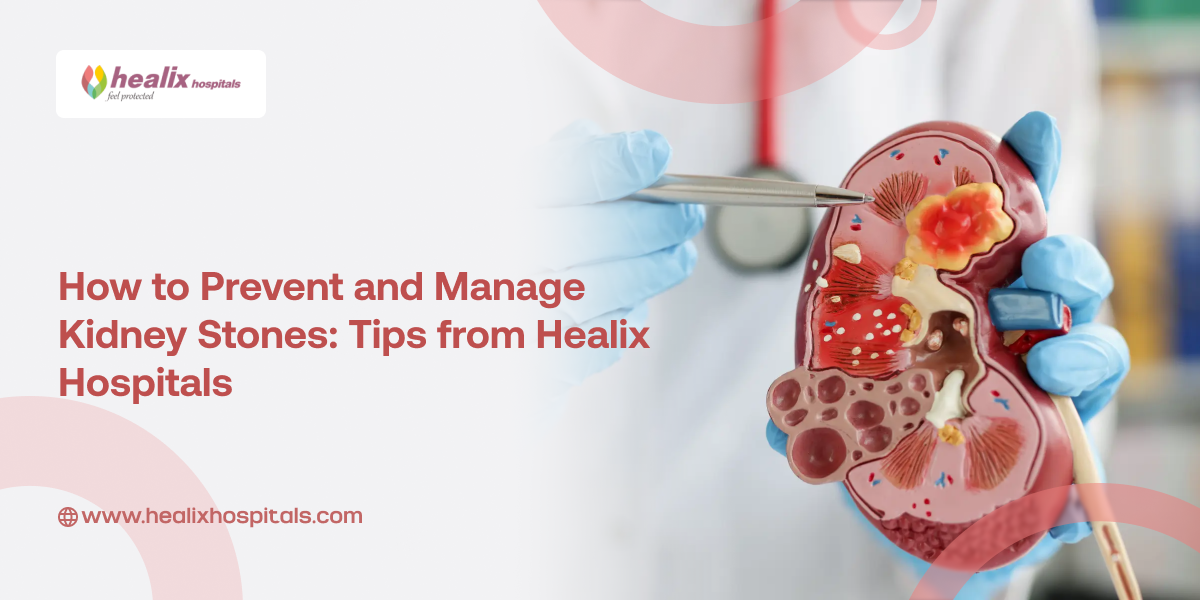 How to Prevent and Manage Kidney Stones: Tips from Healix Hospitals