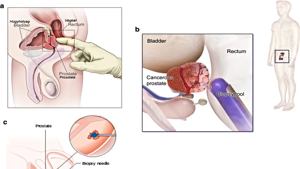 Prostate Cancer Screening Needs a Massage! 