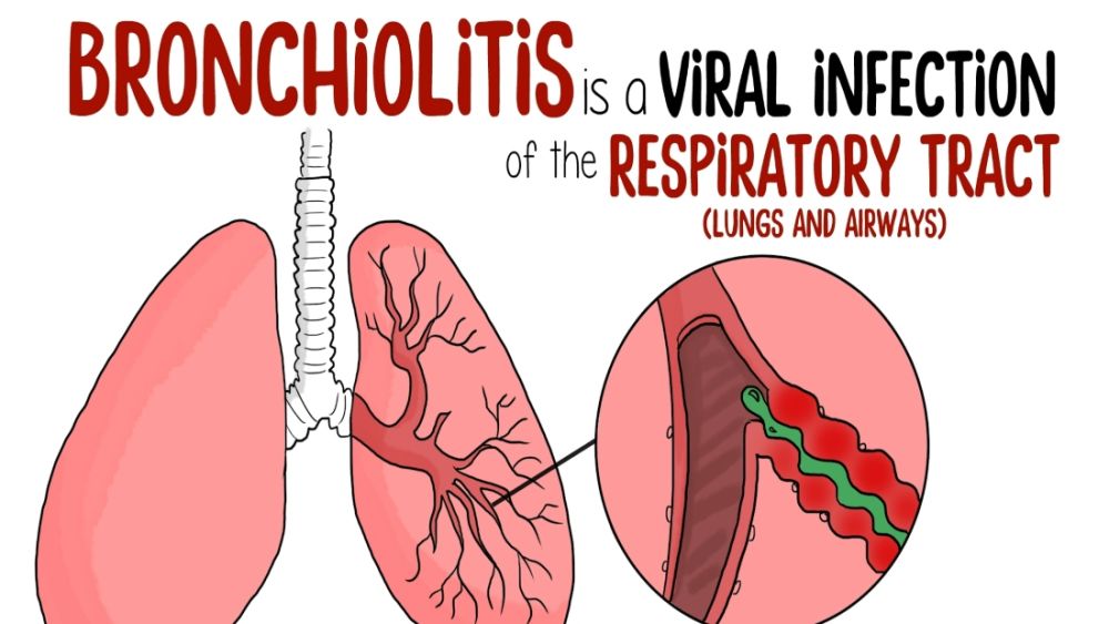 Bronchiolitis