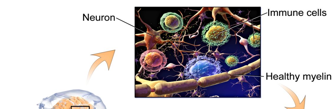 Multiple Sclerosis: Could This Be The Cure?