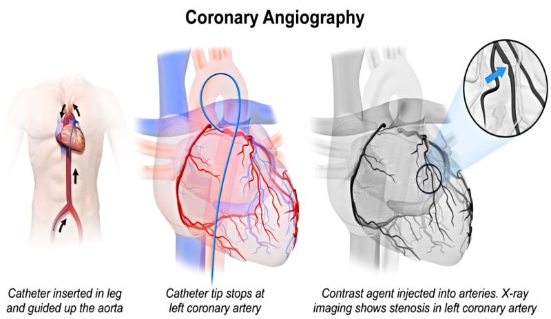 Coronary Angiography