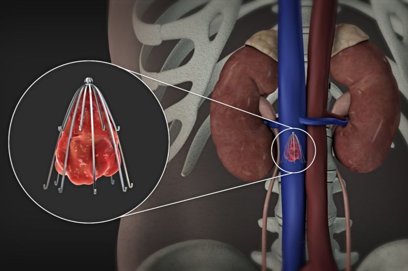 IVC Filters