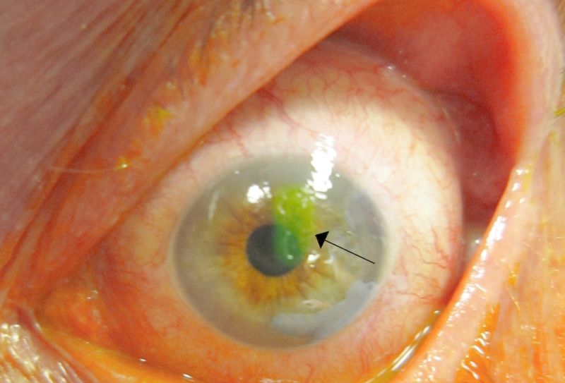 Corneal Abrasion